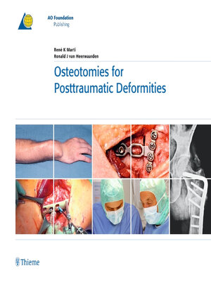 cover image of Osteotomies for Posttraumatic Deformities